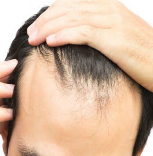 male pattern hair loss treatment