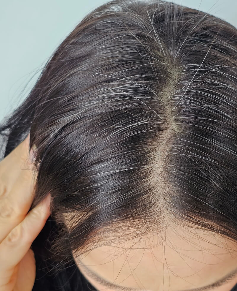 female pattern baldness solutions