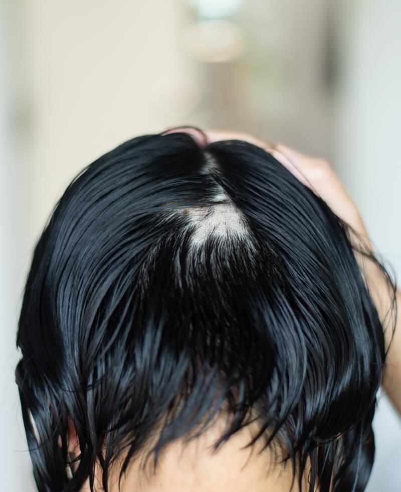 alopecia areata treatment