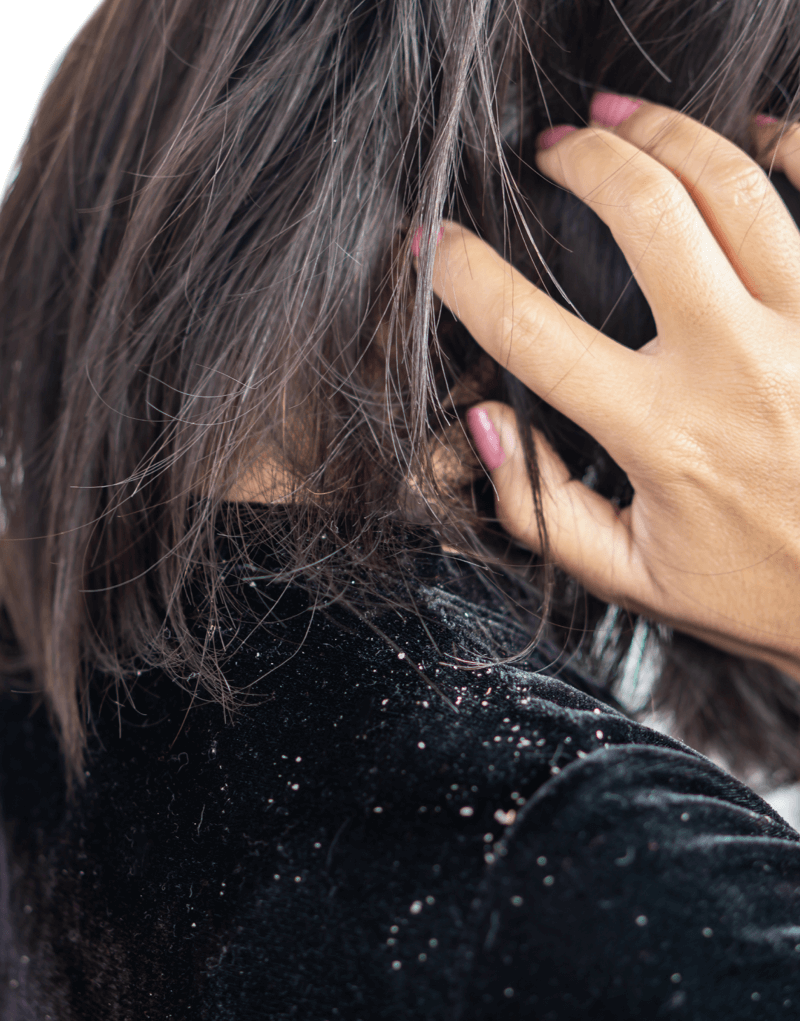 oily scalp treatment