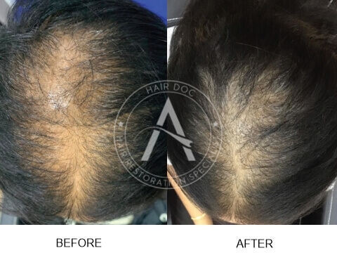 Female Pattern Hair Loss
