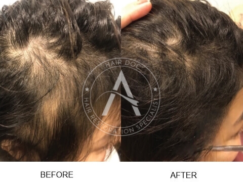 Female Pattern Hair Loss
