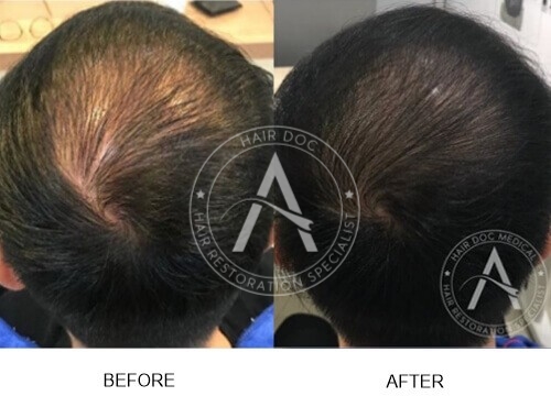 Male Pattern Hair Loss