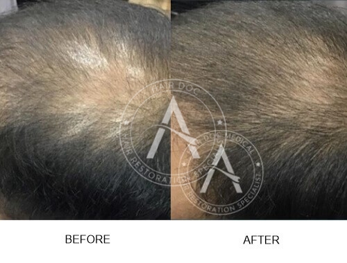 Male Pattern Hair Loss