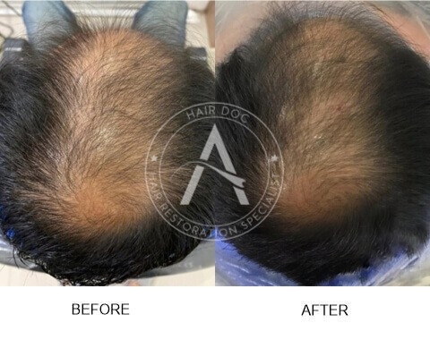 Male Pattern Hair Loss
