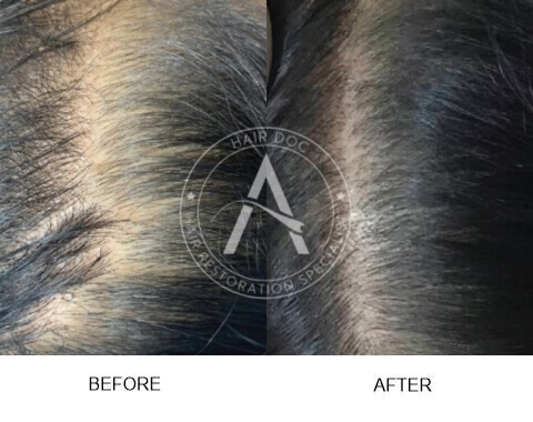 Female Pattern Hair Loss