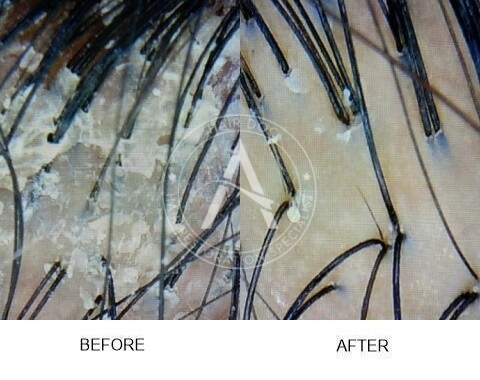 Severe Dandruff Solutions & Scalp Therapy Malaysia | Hair Doc