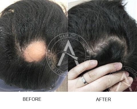 Alopecia Areata