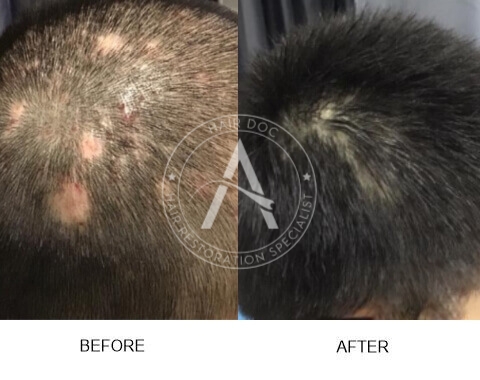 Alopecia Areata