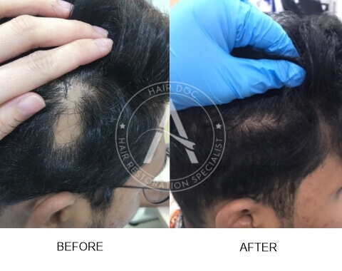 Alopecia Areata