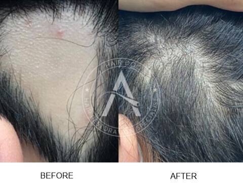 Alopecia Areata